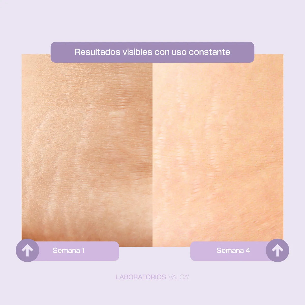 Valca Estrías® | Tratamiento estrias