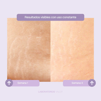 Valca Estrías® | Tratamiento estrias