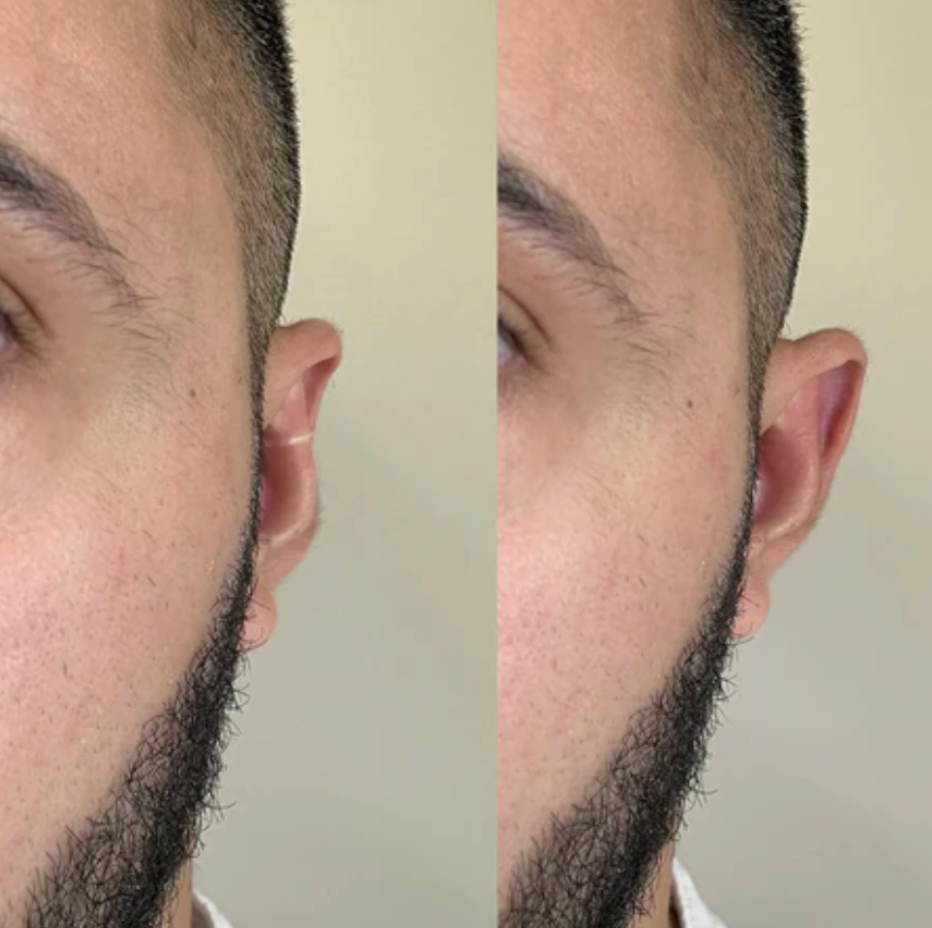 Clip Corrector de Orejas