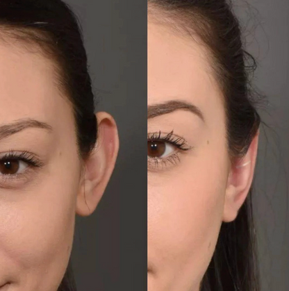 Clip Corrector de Orejas