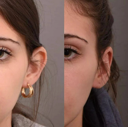 Clip Corrector de Orejas