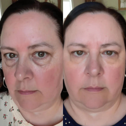 RevitalEyes® — Red Light & EMS Device for Hormone-Related Under-Eye Puffiness
