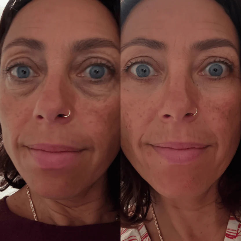 RevitalEyes® — Red Light & EMS Device for Hormone-Related Under-Eye Puffiness