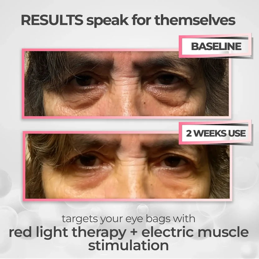 RevitalEyes® — Red Light & EMS Device for Hormone-Related Under-Eye Puffiness