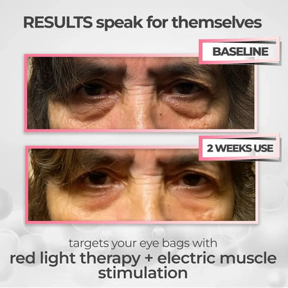 RevitalEyes® — Red Light & EMS Device for Hormone-Related Under-Eye Puffiness
